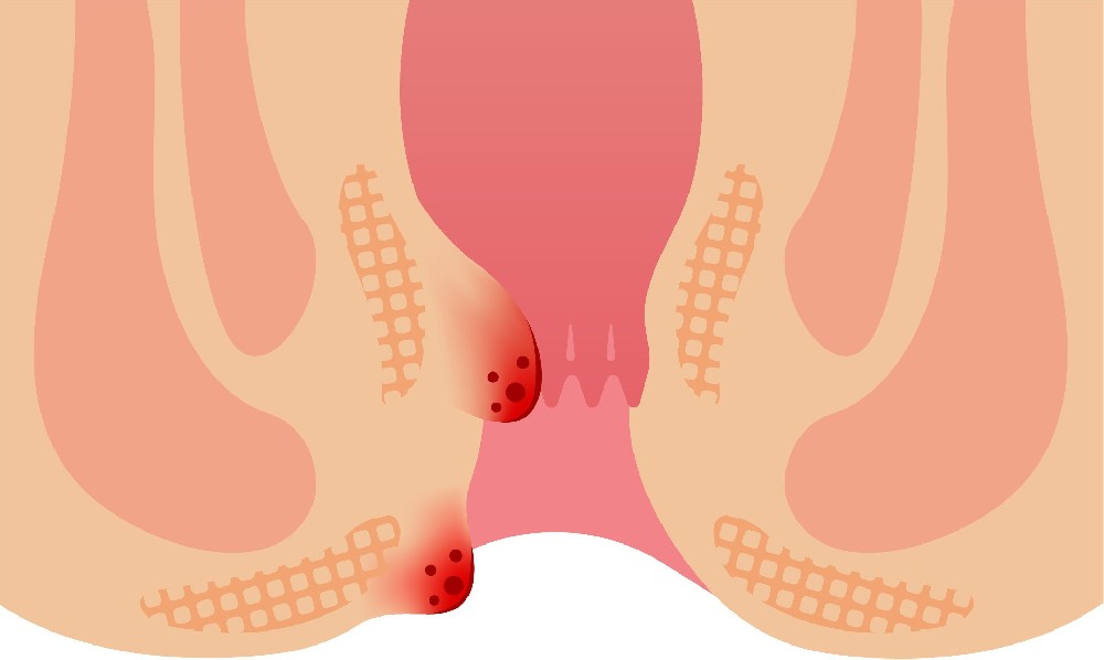 南京肛肠医院;“小小痔疮”，危害却着实不小